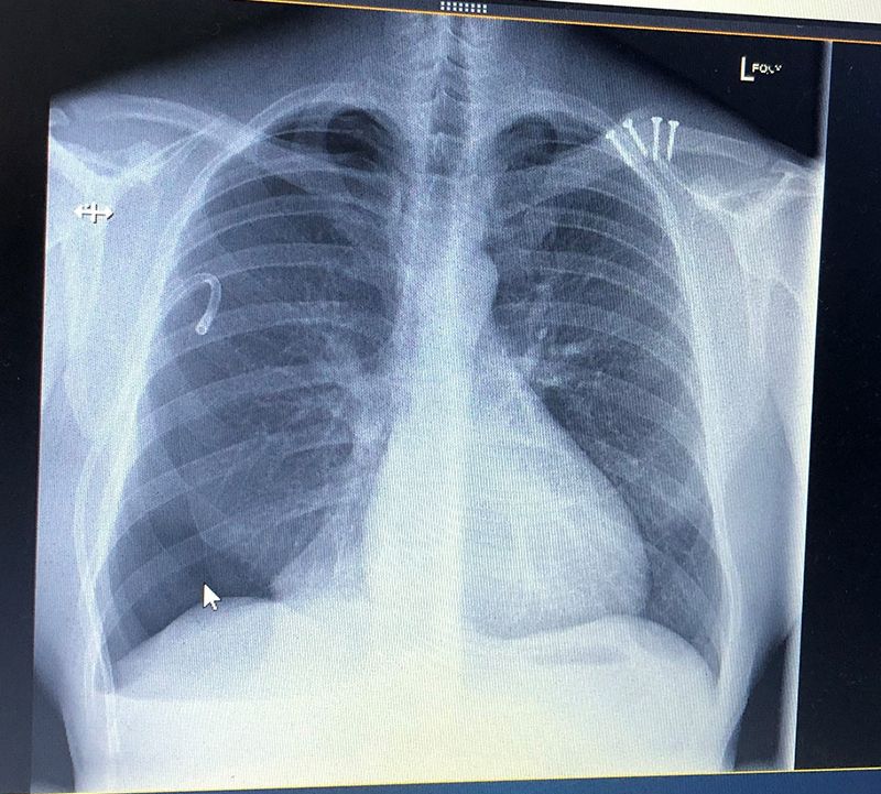 x-ray of collapsed lung