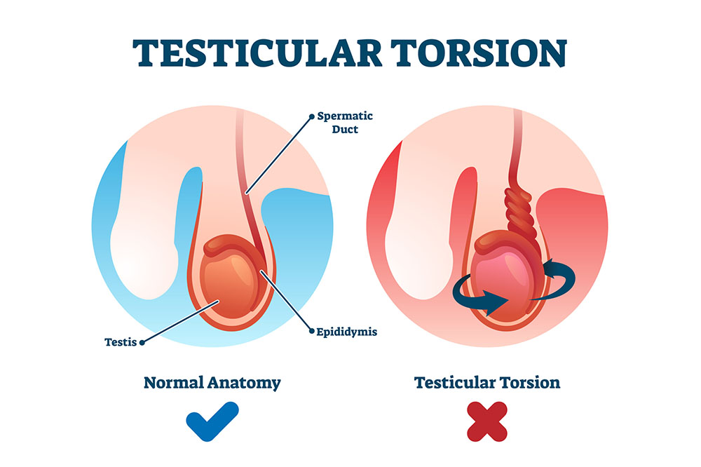 A graphic comparing an internal view of normal testes with testicular torsion showing twisted cord