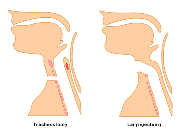 Tracheostomy versus laryngectomy