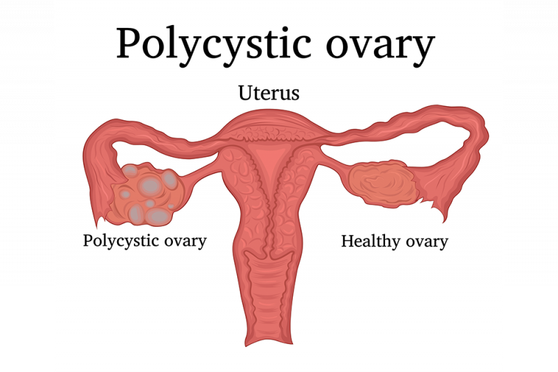 A graphic comparing a normal ovary with a polycystic ovary