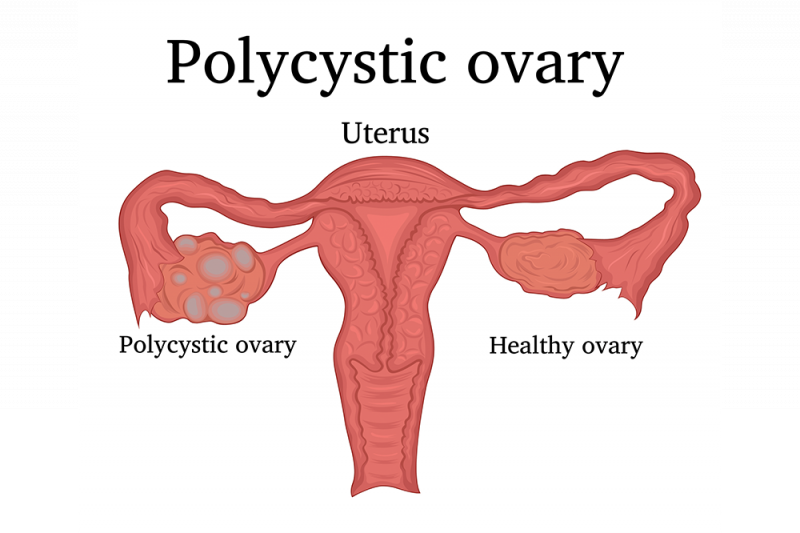 7 Signs You Might Have Polycystic Ovarian Syndrome Queensland Health 7-signs-you-might-have-polycystic-ovarian-syndrome-queensland-health