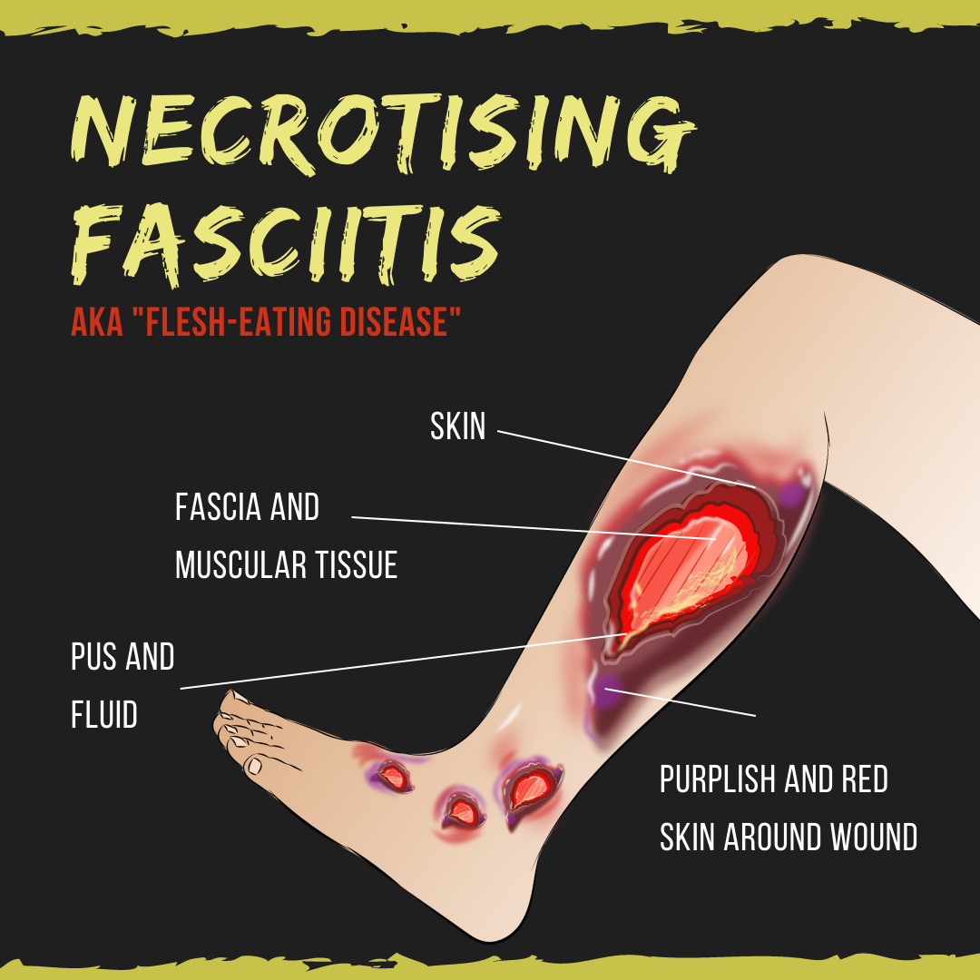 A graphic showing a leg with necrotising fasciitis