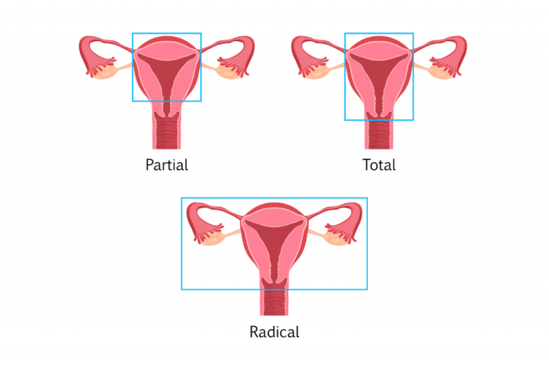 A graphic showing three images of types of hysterectomy - partial, full and radical
