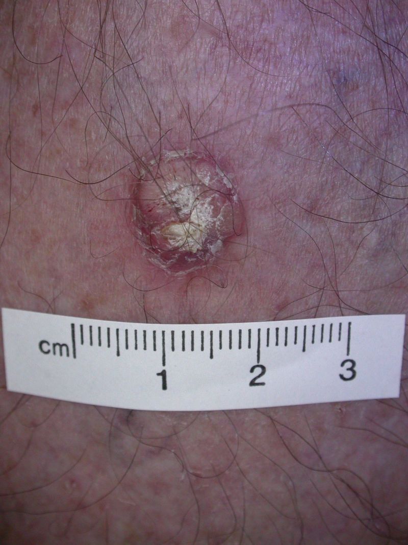 A picture of a squamous cell carcinoma.