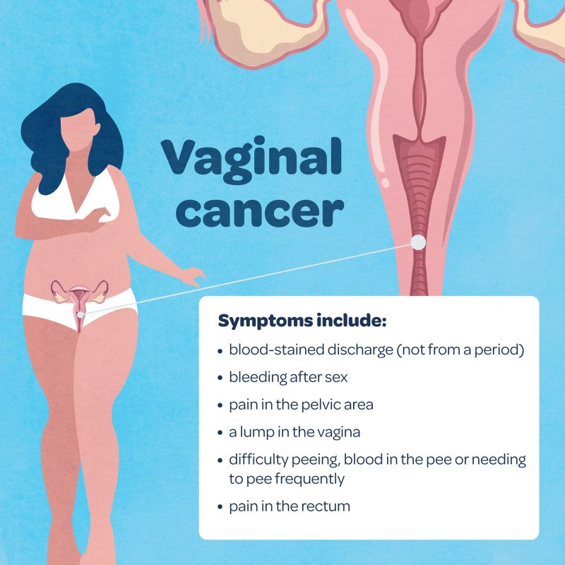 A graphic image showing the symptoms of vaginal cancer, reading: blood-stained discharge (not from a period) · bleeding after sex · pain in the pelvic area · a lump in the vagina · difficulty peeing, blood in the pee or needing to pee frequently · pain in the rectum