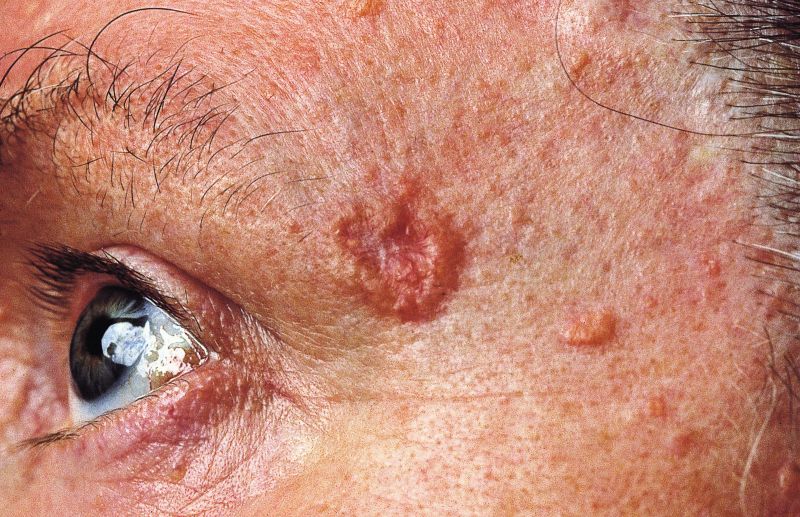 A picture of a basal cell carcinoma on a person's face.