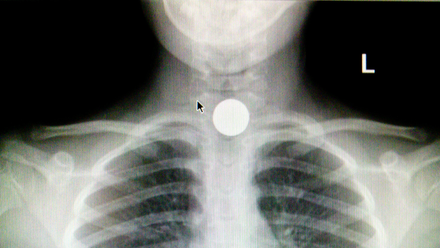 An xray showing a button battery lodged in a person's throat.
