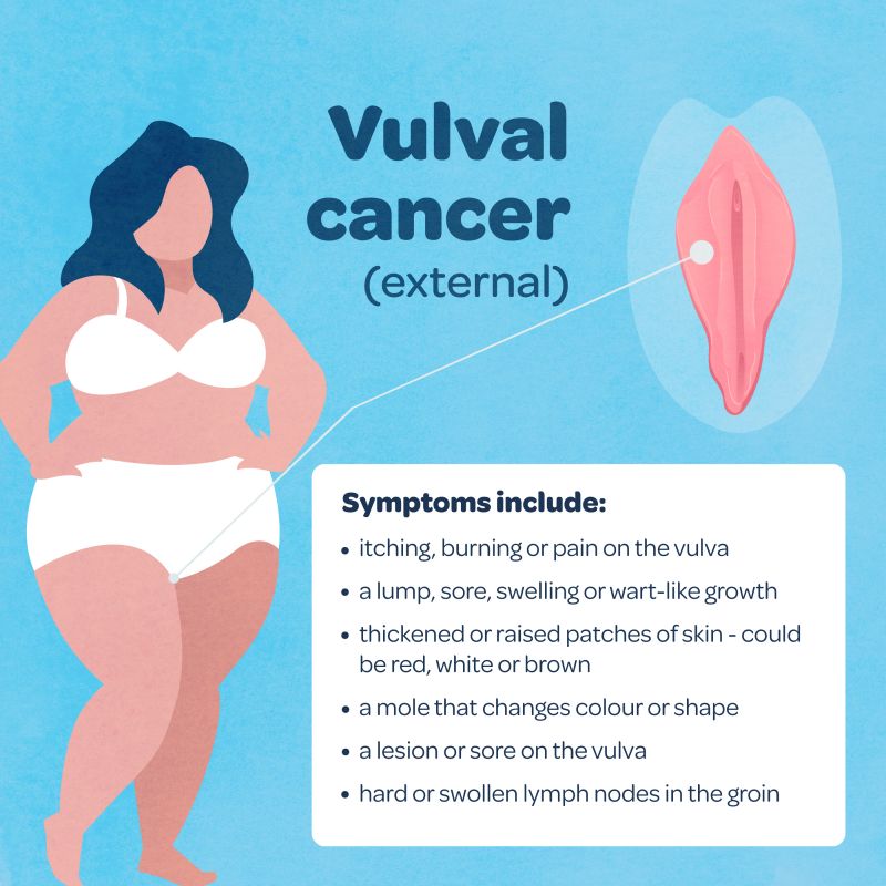 A graphic image showing the symptoms of vulval cancer, reading: itching, burning or pain on the vulva · a lump, sore, swelling or wart-like growth · thickened or raised patches of skin - could be red, white or brown · a mole that changes colour or shape · a lesion or sore on the vulva · hard or swollen lymph nodes in the groin