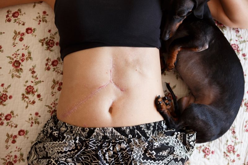 A photo of a woman's torso with a 'Mercedes Benz' scar.