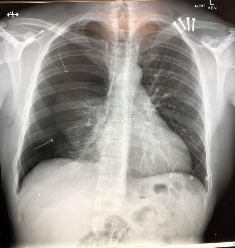 X-ray of lungs