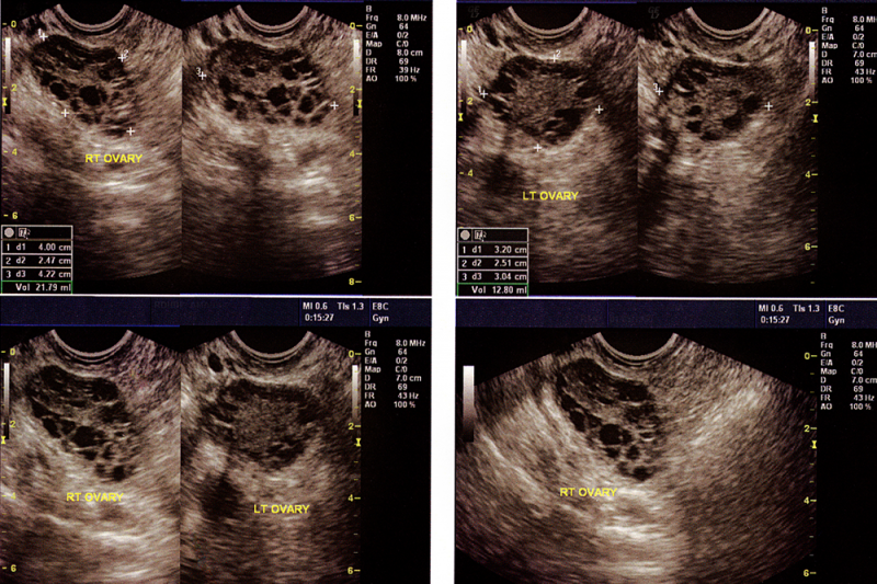 Ultrasound images showing polycystic ovaries