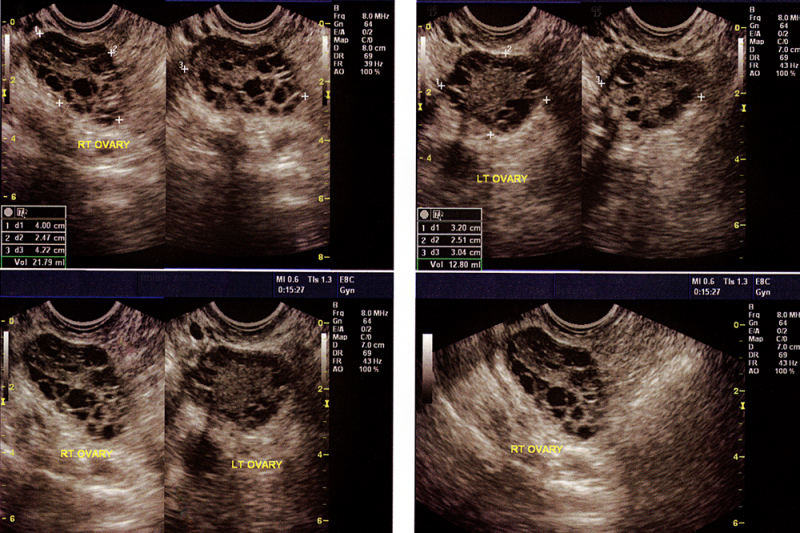 Healthy Ovarian Ultrasound