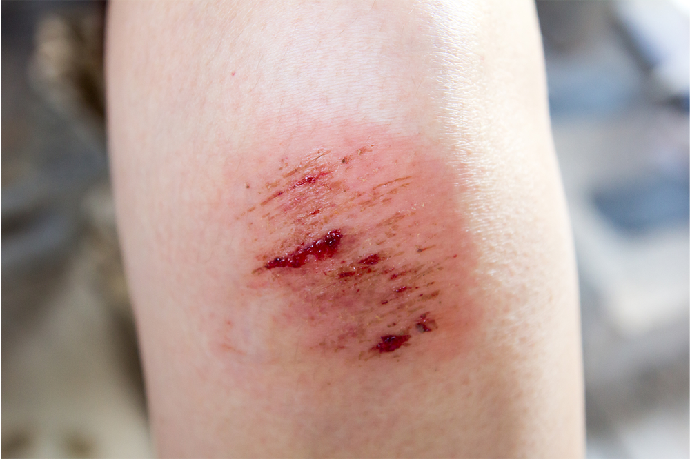 A woman's knee with a minor graze