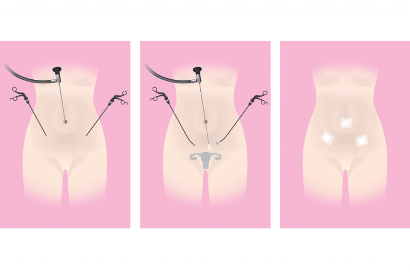 A graphic showing endoscopic hysterectomy procedure