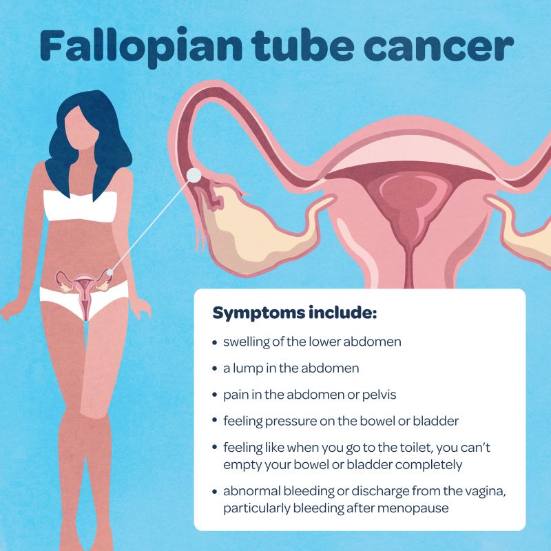 A graphic image showing the symptoms of fallopian tube cancer reading: swelling of the lower abdomen ·        a lump in the abdomen ·        pain in the abdomen or pelvis  ·        feeling pressure on the bowel or bladder ·        feeling like when you go to the toilet, you can’t empty your bowel or bladder completely ·        abnormal bleeding or discharge from the vagina, particularly bleeding after menopause 