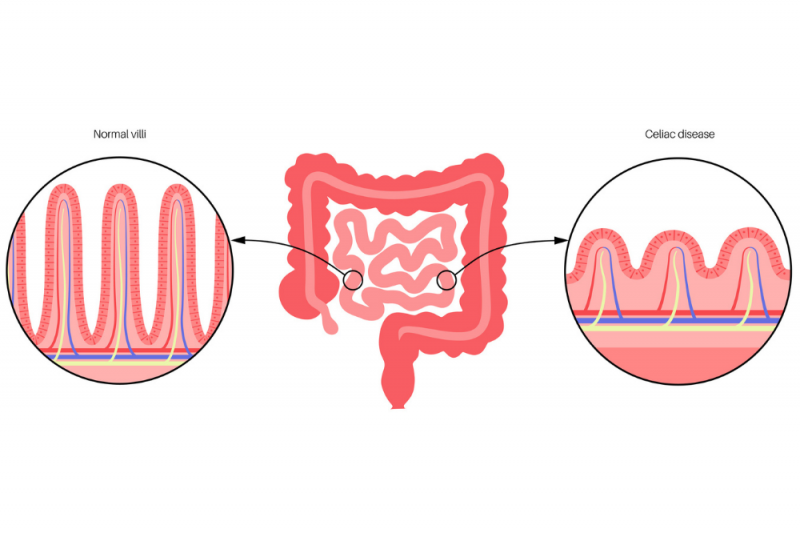 A graphic showing normal villi projections that increase the surface area of the small intestine to better absorb nutrients contracted with villi damaged by coeliac disease