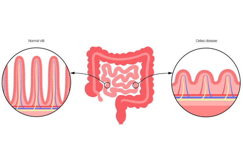 Coeliac Vs Crohn s what s The Difference Queensland Health coeliac-vs-crohn-s-what-s-the-difference-queensland-health