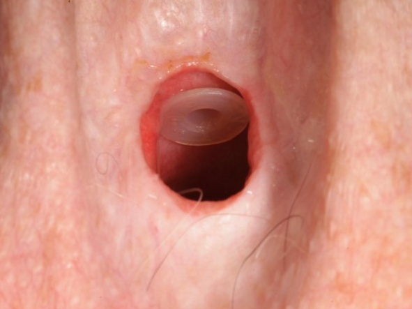 Laryngectomy attachment - voice prosthesis