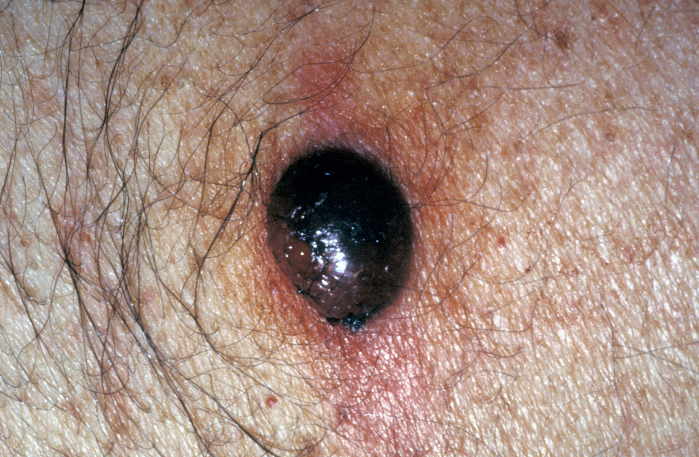 An image showing a nodular melanoma.
