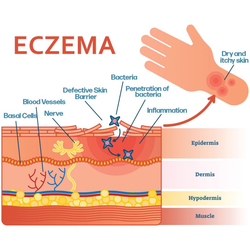 A diagram of the skin wall showing missing Filaggrin allowing bacteria to enter the skin.