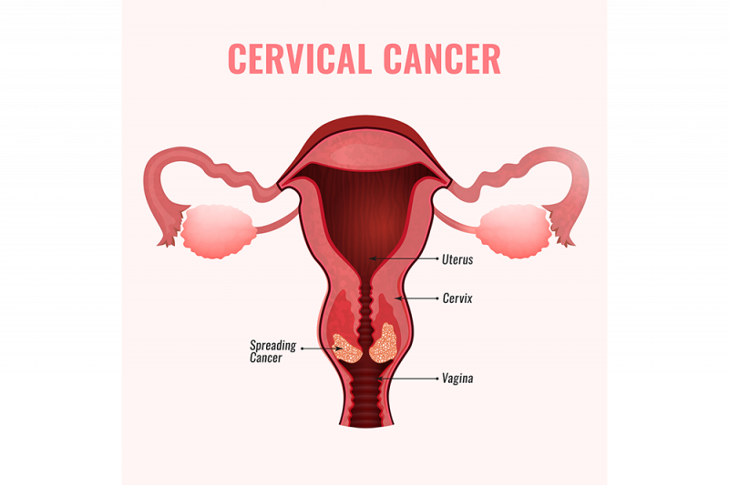 A graphic showing a cross section of a cervix indicating cervical cancer