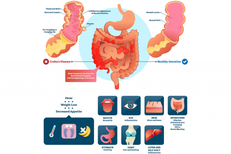A graphic showing the digestive tract from stomach to anus showing how Crohn's disease affects it with additional fat wrapping, abscesses, and thickened intestine walls 