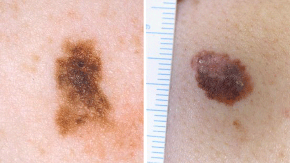 Two images of melanomas.