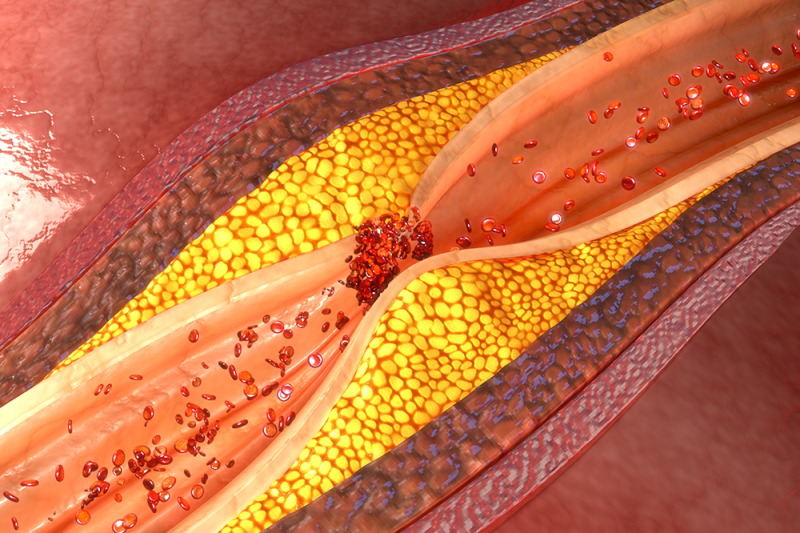 A graphic of an artery showing narrowing caused by plaque and a blood clot forming