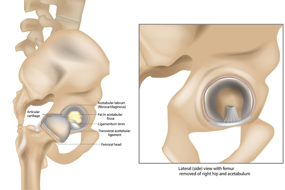 A graphic showing the anatomical features of the hip joint including the pelvis, articular cartilage , acetabular labrum, ligaments and the head of the femur
