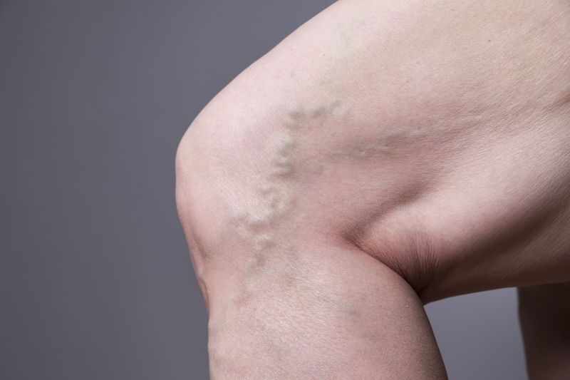 A photo of a knee with varicose veins.