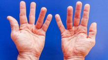 Photograph of two adult male hands against a blue background. The ring fingers of both hands are raised slightly because of Dupuytren's contracture in the palm