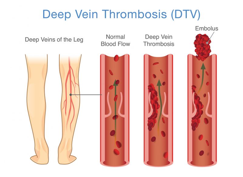 A diagram of DVT forming.