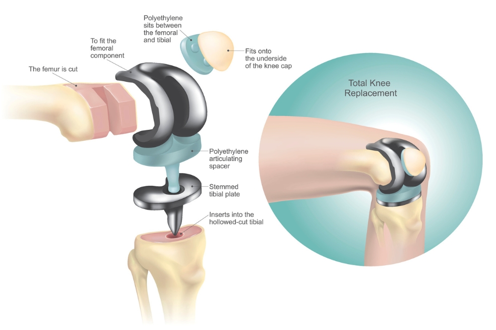 A graphic showing an metal and plastic artificial knee and how the parts are fitted to the bone on the ends of the thigh and shin bones with a plastic spacer in between and another small plastic part under the kneecap