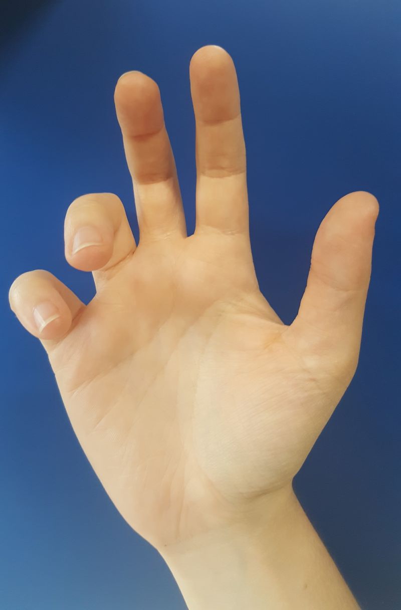 A hand with fingers curling in, demonstrating claw deformity. 