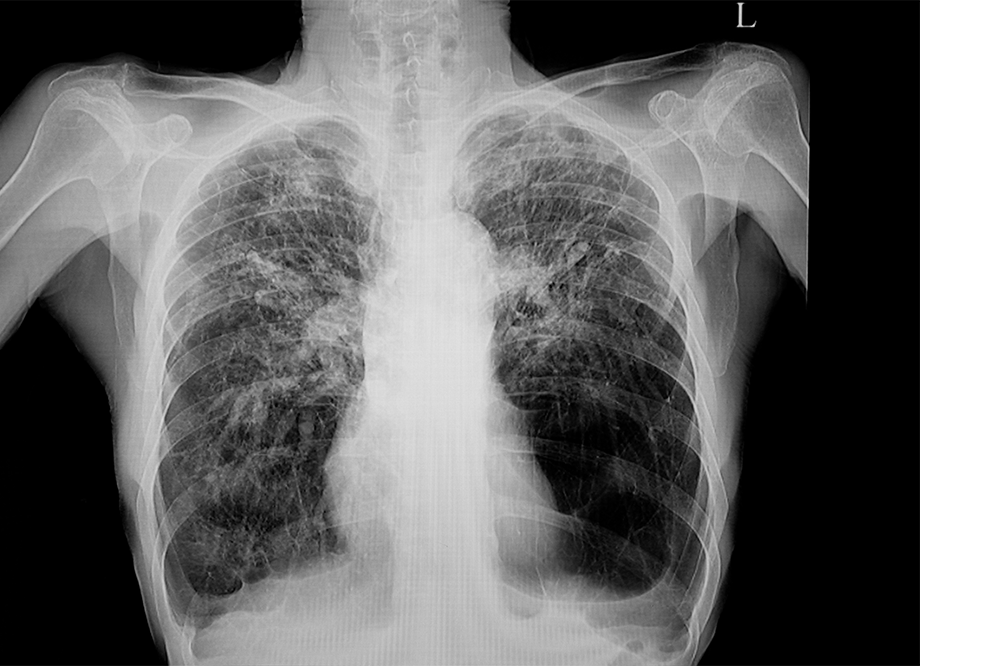 An lung x-ray showing signs of emphysema