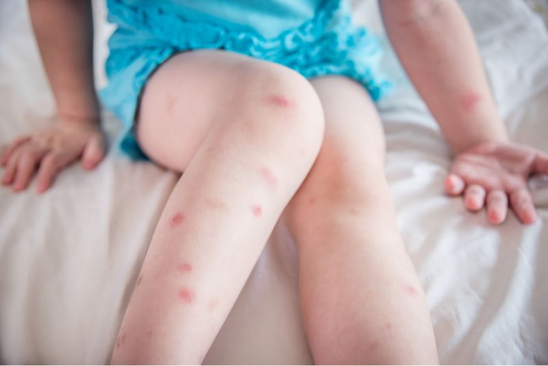 A little girl sits on a bed, her legs covered in red mosquito bites. 