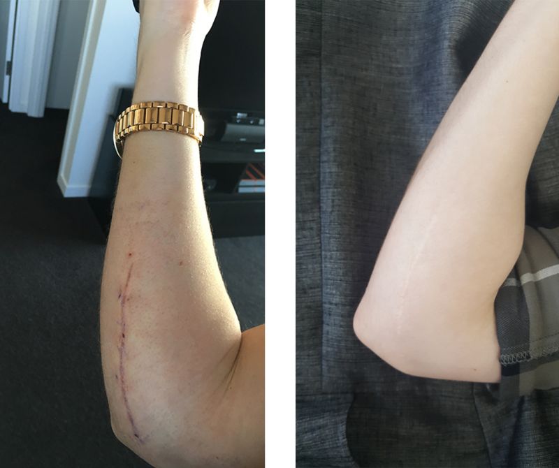 Two photos showing Kat's scar, one week after her surgery and 18 months after.