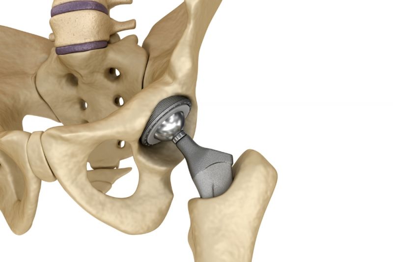 A graphic of a human spine, pelvis and leg, showing an artificial hip joint made of plastic and metal in the left hip and leg