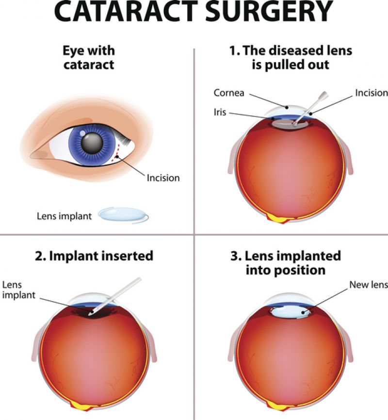 A diagram showing how cataract surgery is performed.