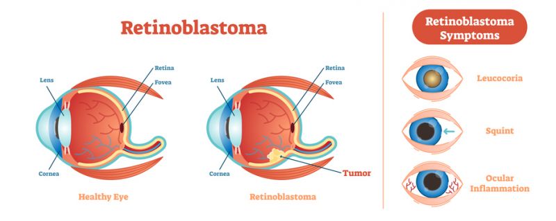 A diagram showing how retinoblastoma forms in the eye.